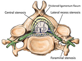Epidural steroid lumbar stenosis